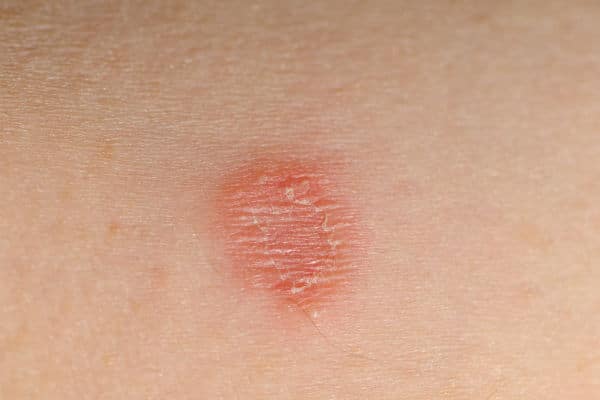 A micose é contagiosa?